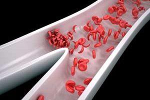 Ischämie: Behandlungsmöglichkeiten und Prävention von Durchblutungsstörungen