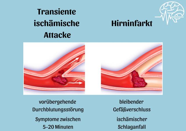 Ischämie: Ursachen, Symptome und Behandlung - Sieu Thi Do Noi That