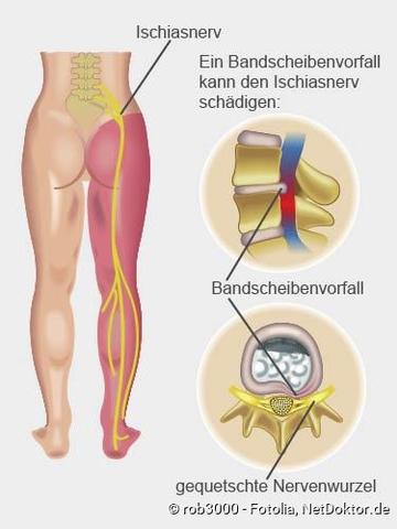Eingeklemmter Ischiasnerv: Wirksame Maßnahmen zur Schmerzlinderung und Heilung Eingeklemmter Ischiasnerv: Wirksame Maßnahmen zur Schmerzlinderung und Heilung