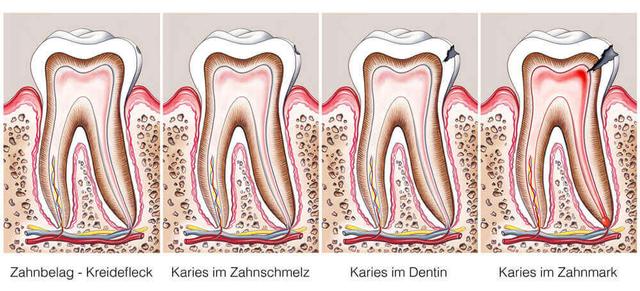 Vorbeugung und Behandlung von Karies im Anfangsstadium: Hausmittel & Tipps Vorbeugung und Behandlung von Karies im Anfangsstadium: Hausmittel & Tipps