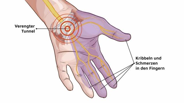 Fingerbeschwerden: Warum Nadelstiche-Schmerzen auf ein Karpaltunnelsyndrom hinweisen könnten Fingerbeschwerden: Warum Nadelstiche-Schmerzen auf ein Karpaltunnelsyndrom hinweisen könnten