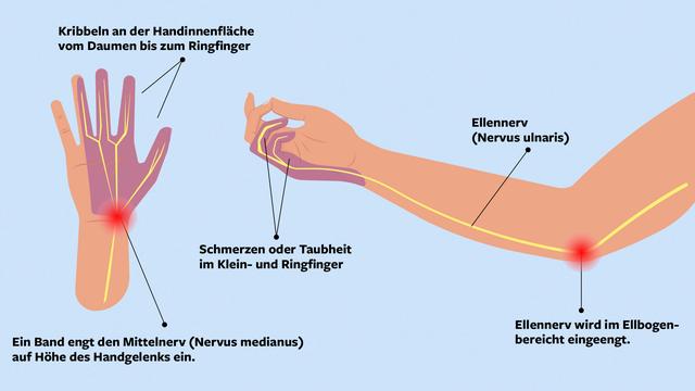 Handchirurg erklärt: Kribbeln und Nadelstiche im Finger als Symptome des Karpaltunnelsyndroms Handchirurg erklärt: Kribbeln und Nadelstiche im Finger als Symptome des Karpaltunnelsyndroms