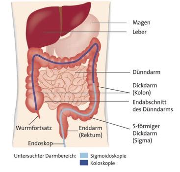 Die Auswirkungen von Milchprodukten auf eine erfolgreiche Darmspiegelung Die Auswirkungen von Milchprodukten auf eine erfolgreiche Darmspiegelung