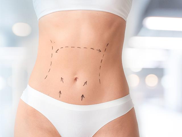 Bauchdeckenstraffung: Welche finanziellen Aufwendungen sind zu erwarten?