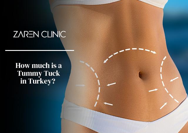 Kosten einer Bauchdeckenstraffung: Was Sie wissen sollten