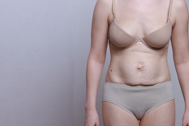 Preise für eine Bauchdeckenstraffung in Nürnberg