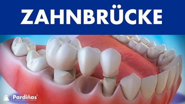 Zahnbrücke mit einem Zahn: Was sind die Kosten?