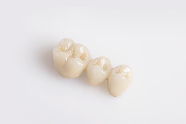 Preisübersicht für eine einzelne Zahnbrücke