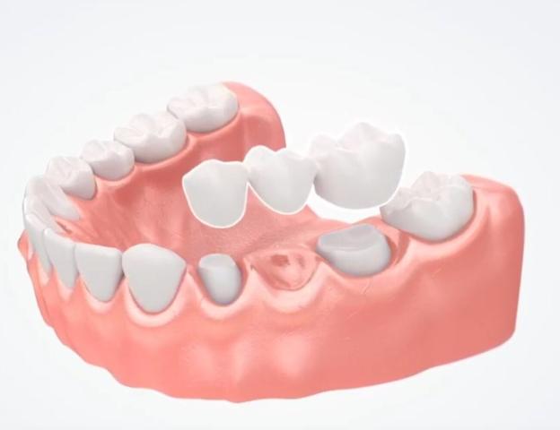 Einzelzahnlücke: Wie viel kostet eine Zahnbrücke?