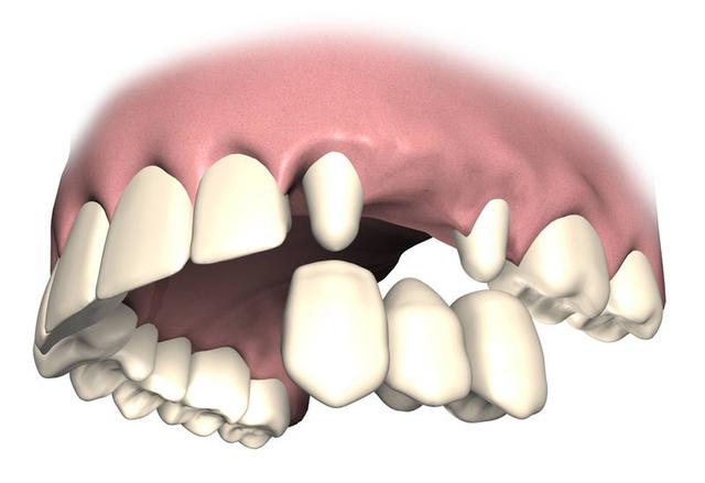 Kostenschätzung für eine Brücke mit einem fehlenden Zahn