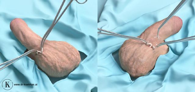 Finanzielle Aspekte einer Vasektomie: Was Sie wissen sollten Finanzielle Aspekte einer Vasektomie: Was Sie wissen sollten