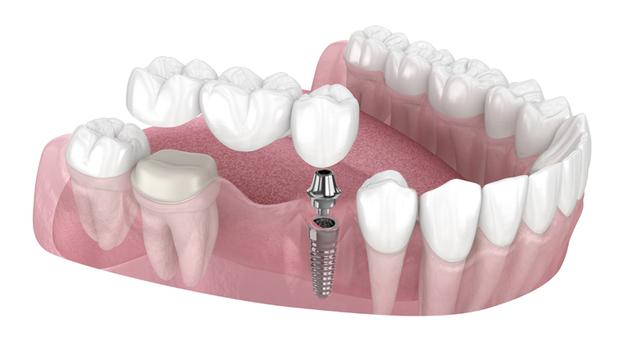 Arten von Zahnbrücken und ihre jeweiligen Kosten