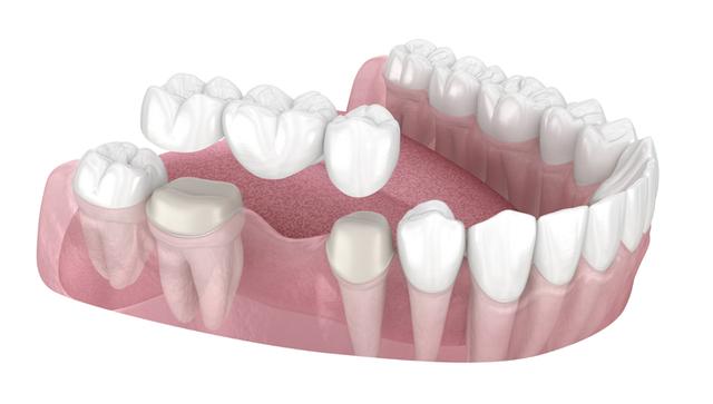 Wann sollte eine Zahnbrücke nicht eingesetzt werden? Informationen zu Risiken und Einschränkungen