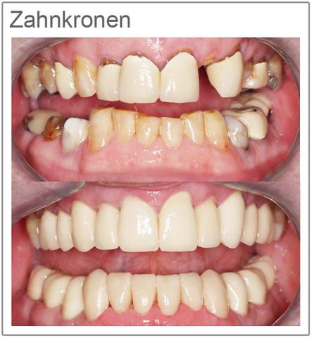 Wie viel kostet eine Zahnkrone? Alle wichtigen Informationen Wie viel kostet eine Zahnkrone? Alle wichtigen Informationen