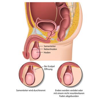 Kosten für Sterilisation: Preise für den dauerhaften Empfängnisschutz Kosten für Sterilisation: Preise für den dauerhaften Empfängnisschutz