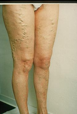 Stützstrümpfe oder operative Entfernung: Was hilft gegen Krampfadern? Stützstrümpfe oder operative Entfernung: Was hilft gegen Krampfadern?