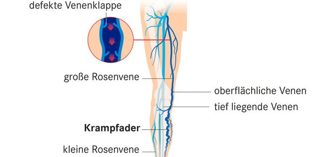 Wie können Krampfadern effektiv behandelt werden? Wie können Krampfadern effektiv behandelt werden?