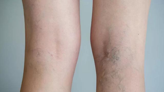 Krampfader-Behandlung: Eingriff, Versiegelung oder Verödung? Krampfader-Behandlung: Eingriff, Versiegelung oder Verödung?