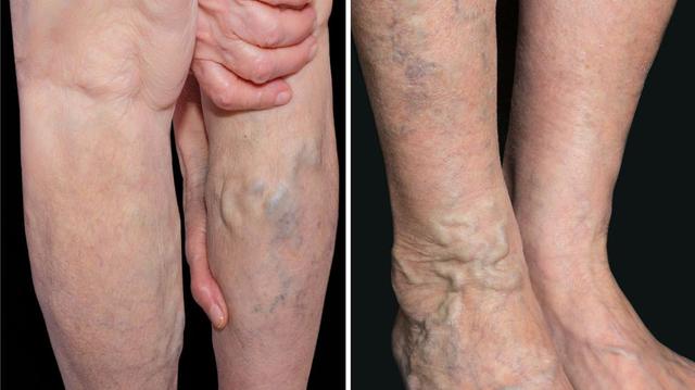 Venenerkrankungen: Warum Krampfadern nicht von alleine heilen und welche Therapiemöglichkeiten es gibt Venenerkrankungen: Warum Krampfadern nicht von alleine heilen und welche Therapiemöglichkeiten es gibt