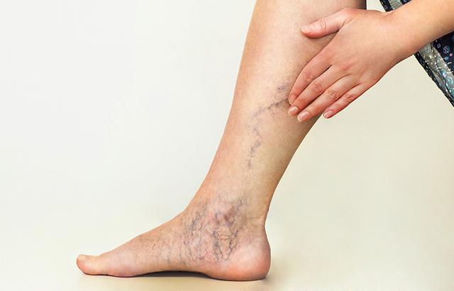 Besenreiser und Krampfadern: Warum sie sich nicht ohne ärztlichen Eingriff zurückbilden und wie man sie behandelt Besenreiser und Krampfadern: Warum sie sich nicht ohne ärztlichen Eingriff zurückbilden und wie man sie behandelt