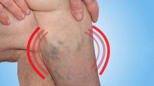 Von alleine verschwinden? Die Wahrheit über das Verschwinden von Krampfadern Von alleine verschwinden? Die Wahrheit über das Verschwinden von Krampfadern