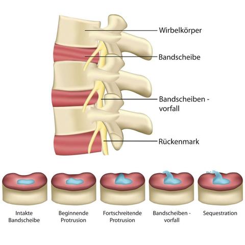 Rechtliche Aspekte: Was darf man während einer Krankschreibung aufgrund eines Bandscheibenvorfalls tun?