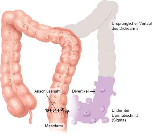 Dauer der Krankschreibung bei Divertikulitis: Was Sie wissen sollten Dauer der Krankschreibung bei Divertikulitis: Was Sie wissen sollten