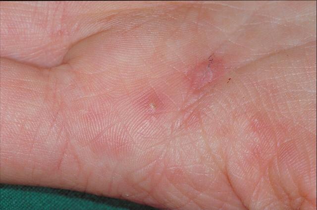 Krätzmilben auf der Haut: Wie sehen sie aus? Krätzmilben auf der Haut: Wie sehen sie aus?