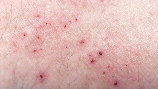 Behandlung von Krätze: Cremes, Tabletten und Hygienemaßnahmen Behandlung von Krätze: Cremes, Tabletten und Hygienemaßnahmen