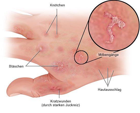 Krätze: Symptome, Übertragungswege und Behandlung Krätze: Symptome, Übertragungswege und Behandlung