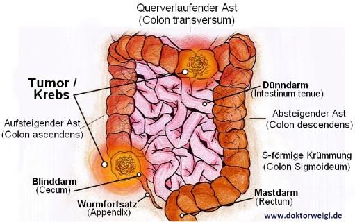 Ursachen von Darmkrebs: Faktoren, die zur Entstehung von Darmkrebs beitragen können Ursachen von Darmkrebs: Faktoren, die zur Entstehung von Darmkrebs beitragen können