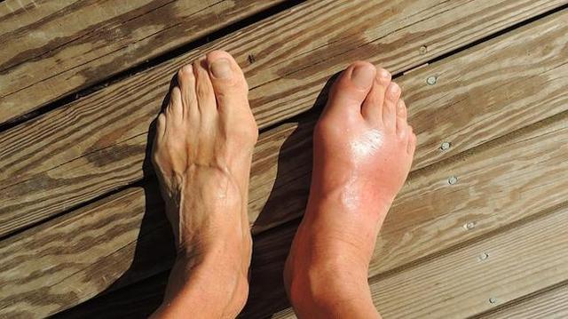 Was darf man bei Gicht nicht essen und trinken? Eine Tabelle mit den wichtigsten Informationen Was darf man bei Gicht nicht essen und trinken? Eine Tabelle mit den wichtigsten Informationen