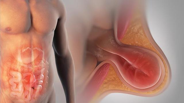 Alternative Behandlungsmethoden für Leistenbrüche: Selbstheilung im Fokus Alternative Behandlungsmethoden für Leistenbrüche: Selbstheilung im Fokus