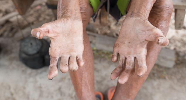 Alles, was Sie über Lepra wissen müssen