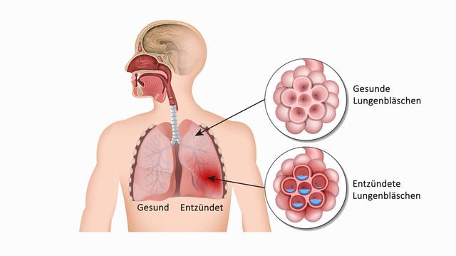Ruhe und Schonung bei Lungenentzündung: Wie lange ist es notwendig? Ruhe und Schonung bei Lungenentzündung: Wie lange ist es notwendig?