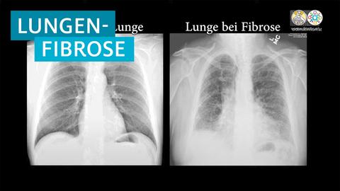 Lungenfibrose im Detail: Entstehung, Diagnose und mögliche Therapien Lungenfibrose im Detail: Entstehung, Diagnose und mögliche Therapien