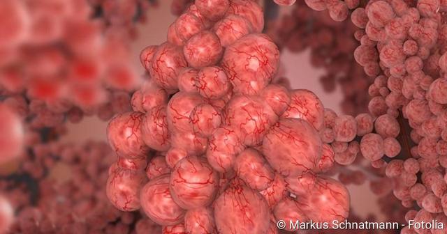 Alles Wissenswerte über Lungenfibrose: Ursachen, Symptome und Prognose