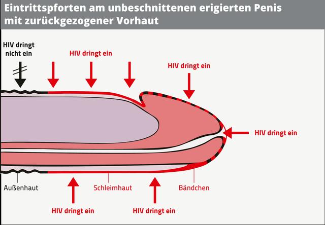 Verbindung zwischen Lusttropfen und HIV-Infektion Verbindung zwischen Lusttropfen und HIV-Infektion
