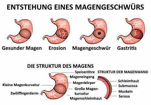 Wie Sie Ihr Magengeschwür ohne medizinische Behandlung selbst heilen können Wie Sie Ihr Magengeschwür ohne medizinische Behandlung selbst heilen können