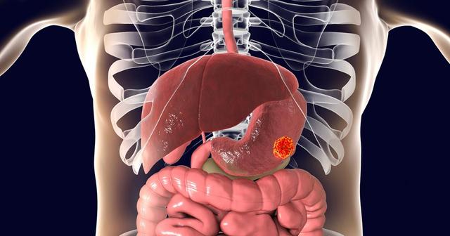 Symptome von Magenkrebs: Wie haben Sie es bemerkt? Symptome von Magenkrebs: Wie haben Sie es bemerkt?