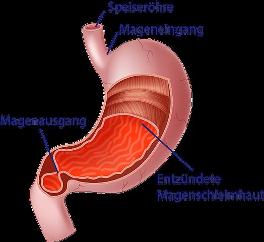 Effektive Behandlungsmethoden bei Magenschleimhautentzündung Effektive Behandlungsmethoden bei Magenschleimhautentzündung