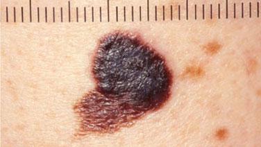 Vorbeugung von Melanomen: Tipps zur Vermeidung von Hautkrebs Vorbeugung von Melanomen: Tipps zur Vermeidung von Hautkrebs