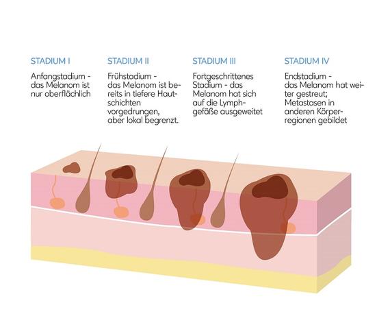 Behandlungsmöglichkeiten bei Melanomen: Operation, Bestrahlung und mehr Behandlungsmöglichkeiten bei Melanomen: Operation, Bestrahlung und mehr