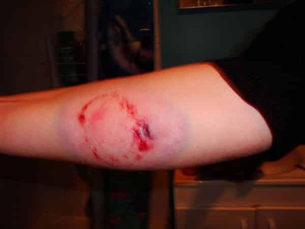 Menschenbiss: Ab wann sollte man einen Arzt konsultieren? Menschenbiss: Ab wann sollte man einen Arzt konsultieren?