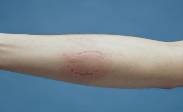 Wann zum Arzt bei einer Bissverletzung durch einen Menschen? Wann zum Arzt bei einer Bissverletzung durch einen Menschen?