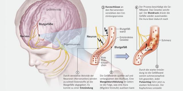 Welche Maßnahmen können bei Migräne mit Aura helfen? Welche Maßnahmen können bei Migräne mit Aura helfen?