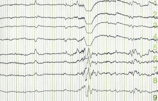 Interpretation von auffälligen EEG-Bildern: Was sie bedeuten können Interpretation von auffälligen EEG-Bildern: Was sie bedeuten können