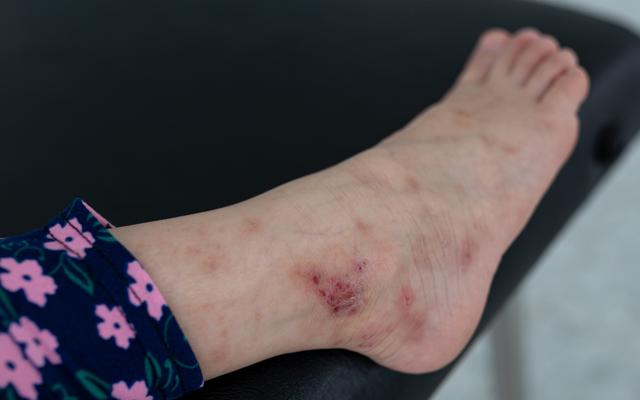 Schwellung nach Mückenstich: Wann ist ein Besuch beim Arzt ratsam? Schwellung nach Mückenstich: Wann ist ein Besuch beim Arzt ratsam?