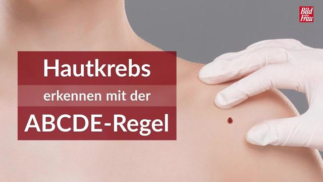 Sicherheit geht vor: Wann sollte man Muttermale lieber vom Hautarzt entfernen lassen? Sicherheit geht vor: Wann sollte man Muttermale lieber vom Hautarzt entfernen lassen?