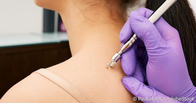 Kosten und Risiken beachten: Muttermale selbst entfernen mit Hausmitteln wie Apfelessig Kosten und Risiken beachten: Muttermale selbst entfernen mit Hausmitteln wie Apfelessig